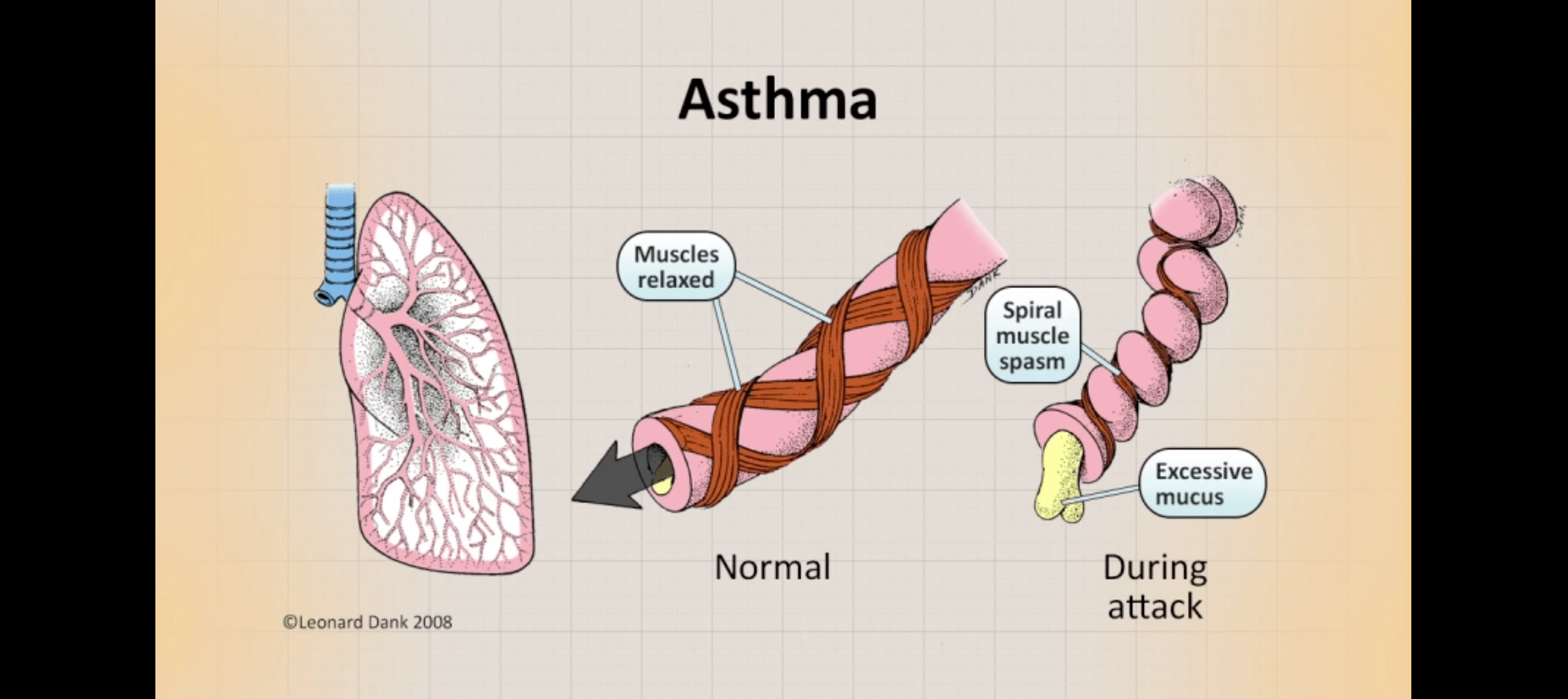 asthmapathology.png